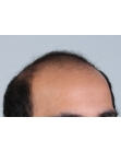 Before Hair Transplant&nbsp;Front